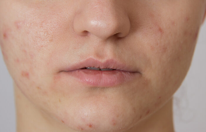 Acne in teenagers