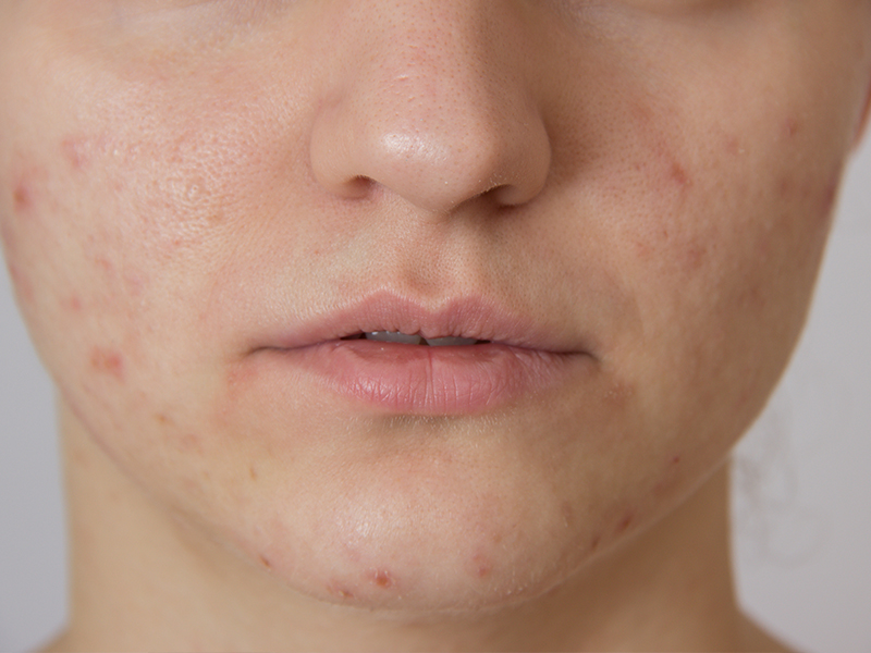 Acne in teenagers