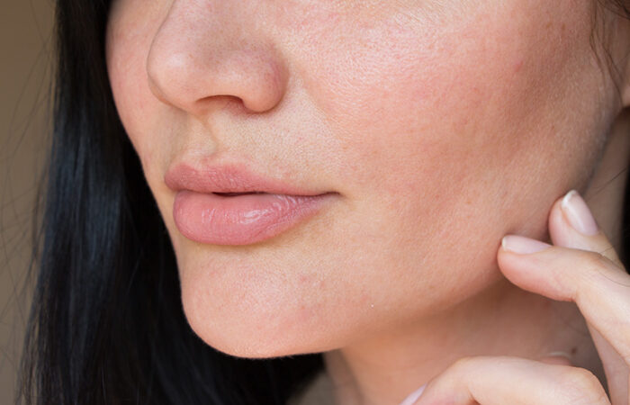 Dry and dehydrated skin Treatment