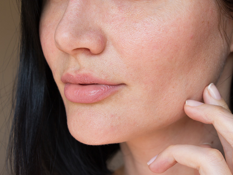 Dry and dehydrated skin Treatment