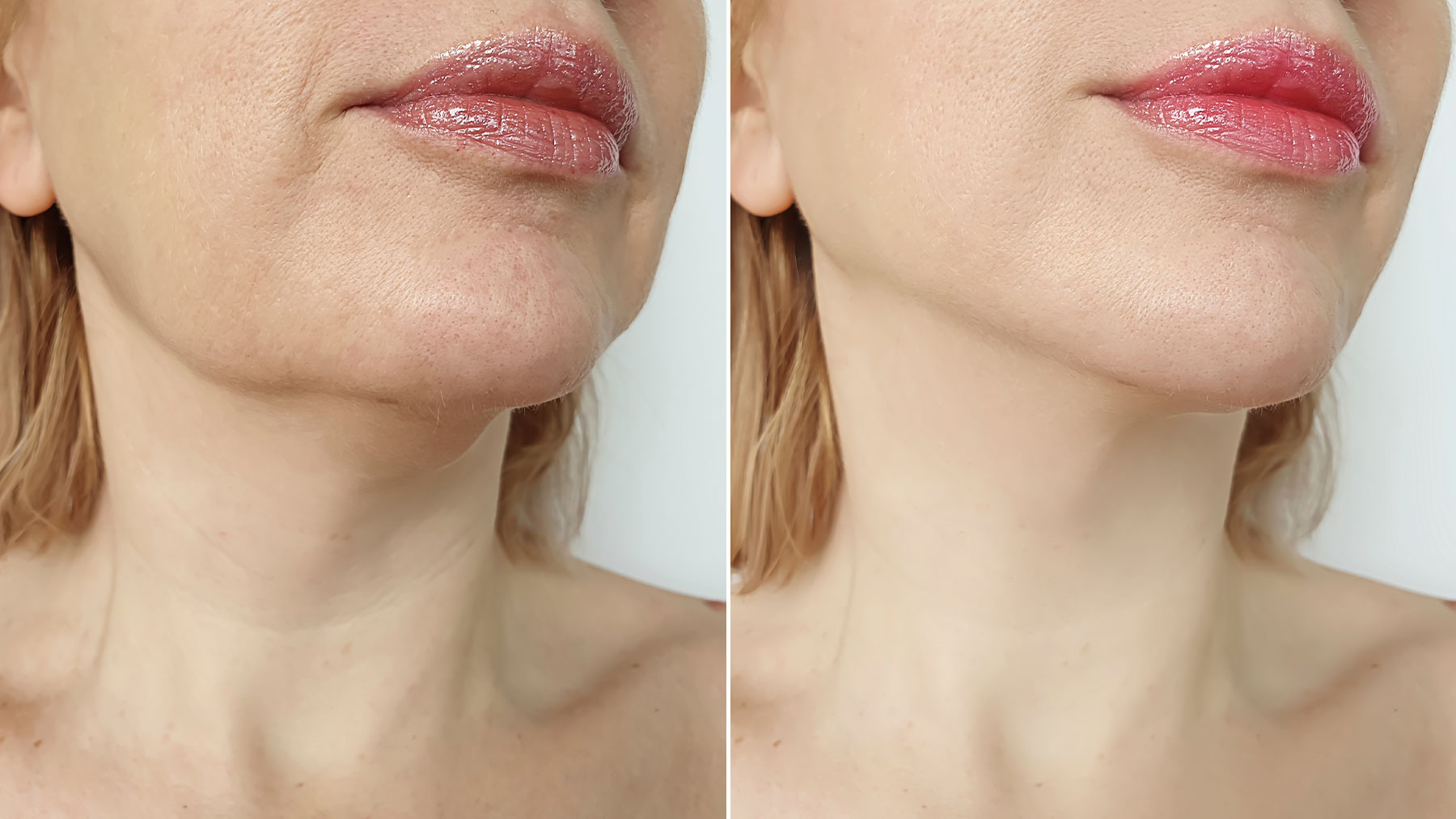 Double Chin Correction