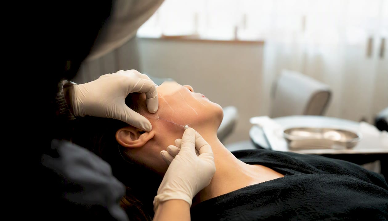 Clinician inserting PDO thread into facial skin