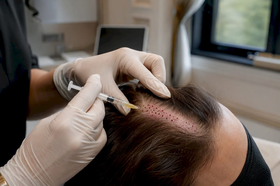 Clinician injecting PRP into scalp close-up