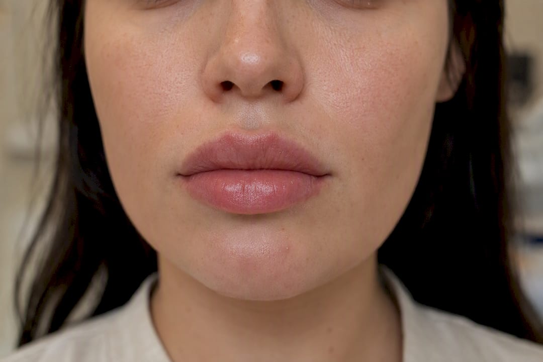 Close-up of swollen lips after filler
