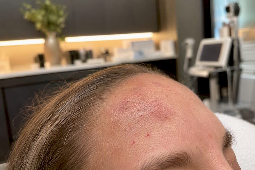 Close-up of mild bruising after Botox injection