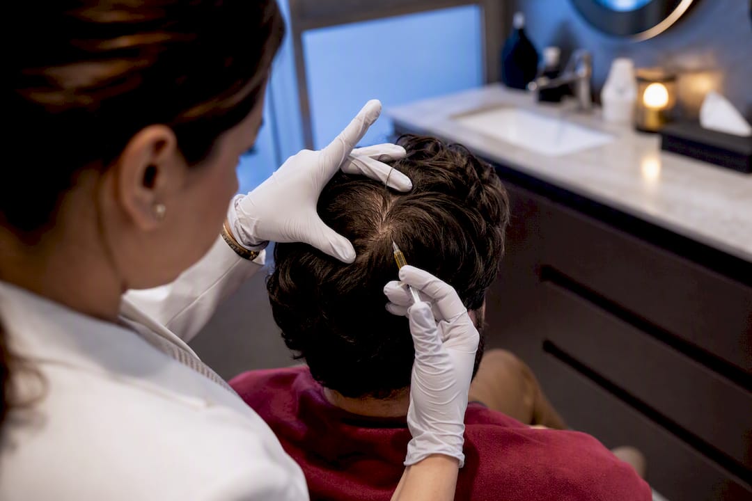 Clinician performing PRP scalp treatment
