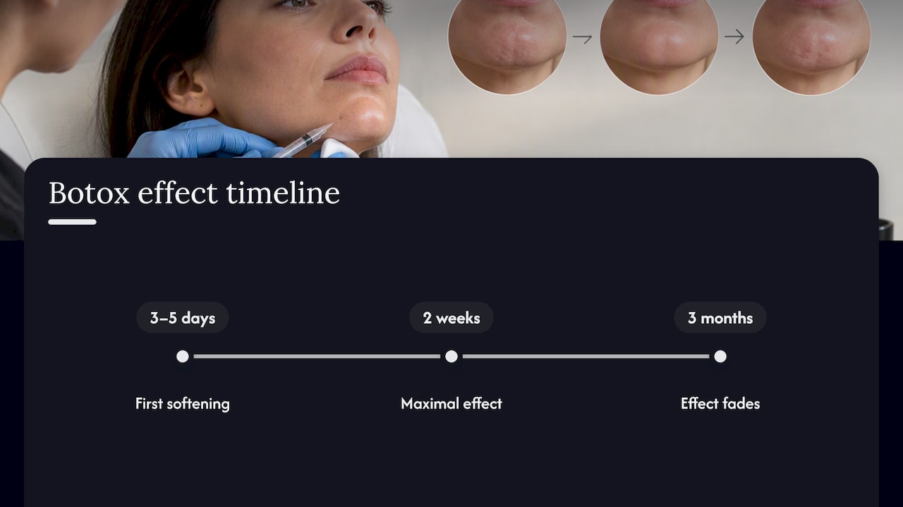 Botox chin results timeline from onset to duration